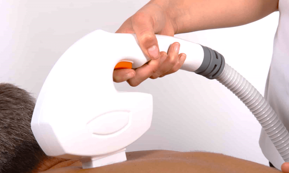 إزالة الشعر بالليزر