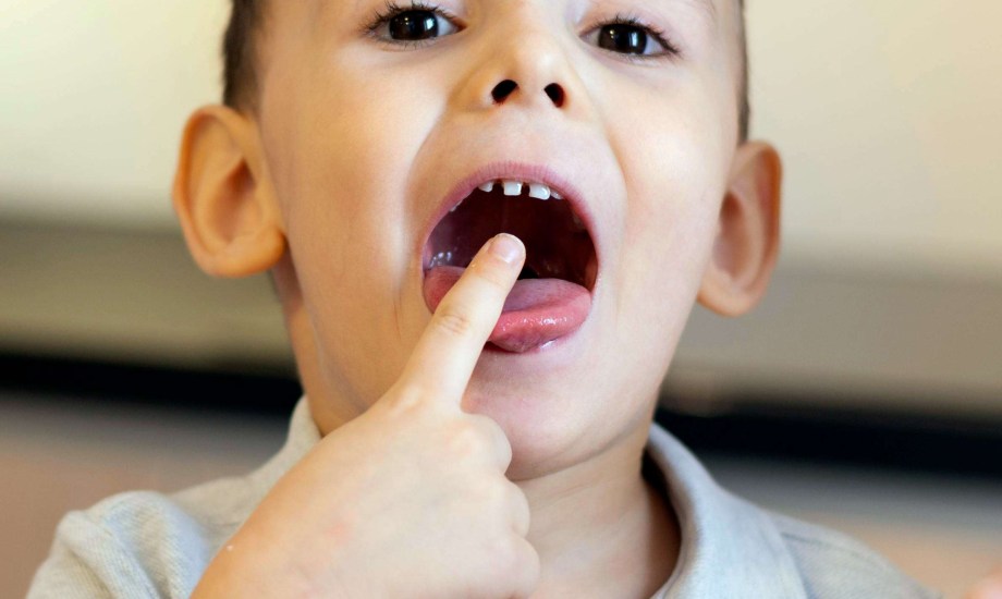 التصاق اللسان عند الأطفال