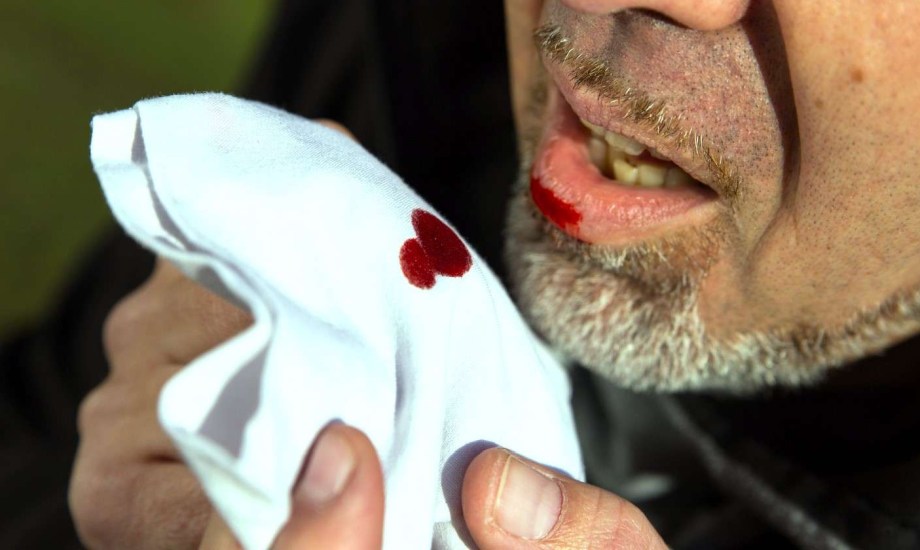 خروج الدم أثناء السعال يشير إلى 7 حالات صحية