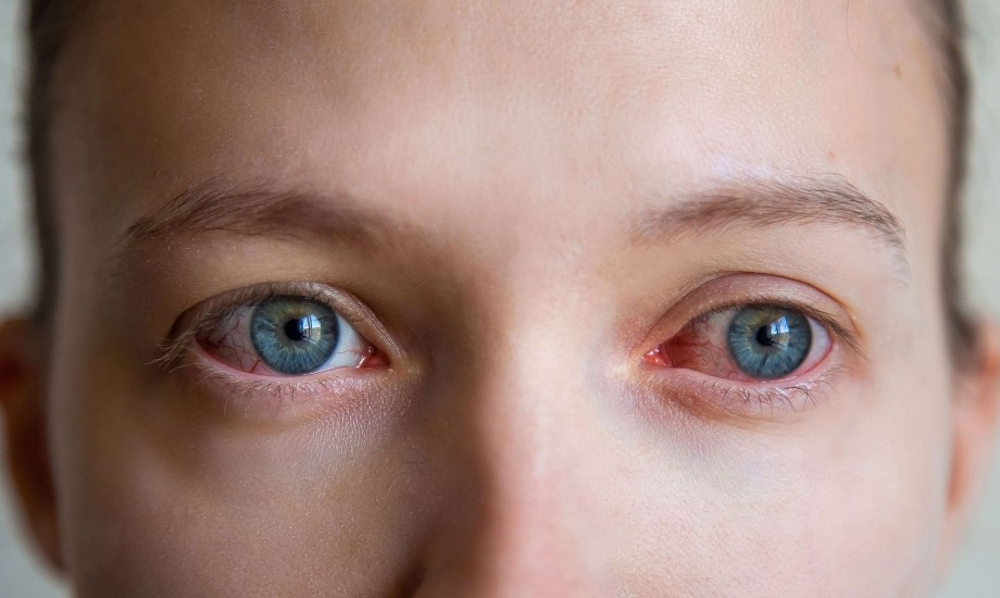 أمراض العيون