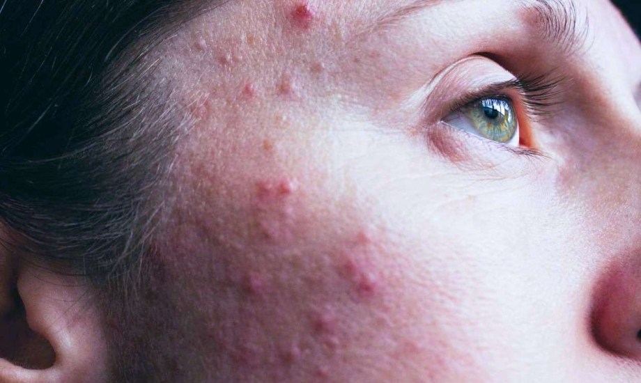 علاج آثار حب الشباب