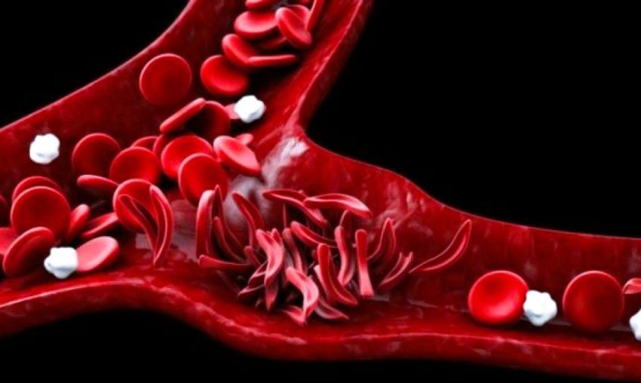 الموافقة على أول علاج لفقر الدم لمرضى الثلاسيميا 