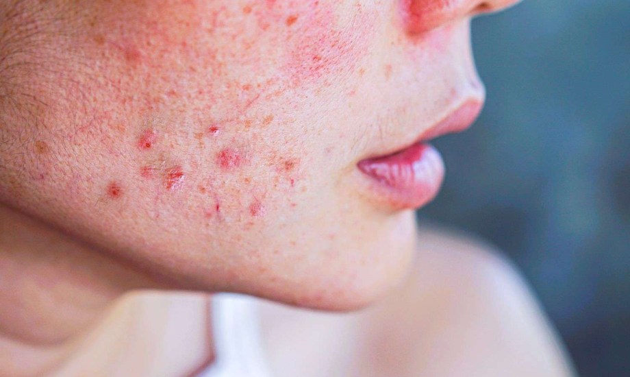 اطعمة تسبب حبوب الوجه