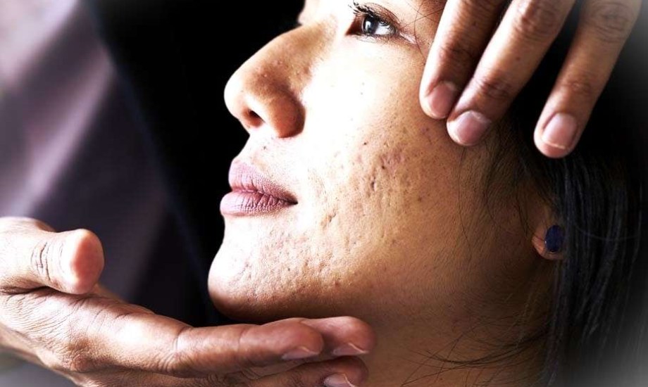 ندبات حب الشباب