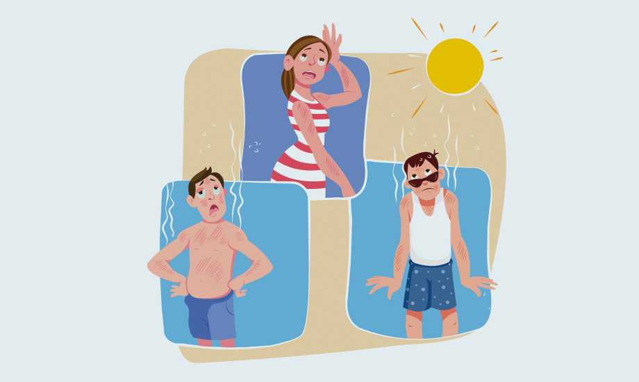 علاجات منزلية لحروق الشمس