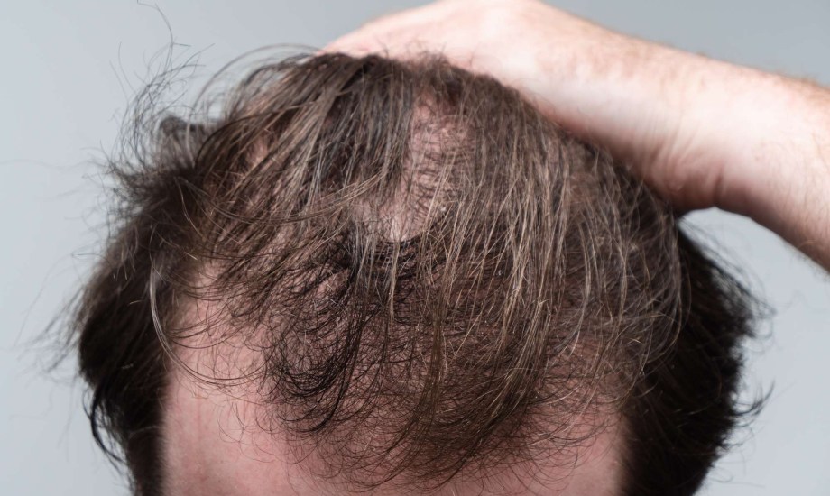 مكافحة تساقط الشعر 