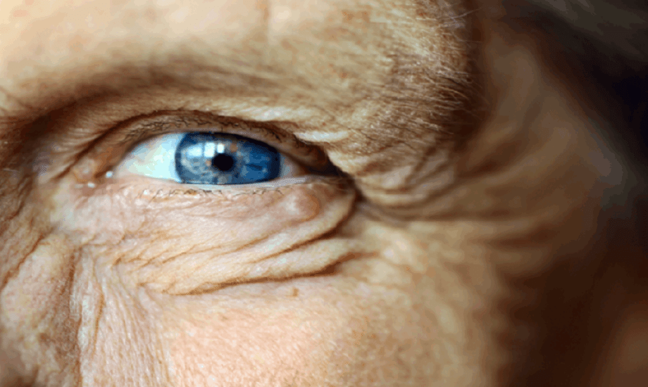 متلازمة بنسون