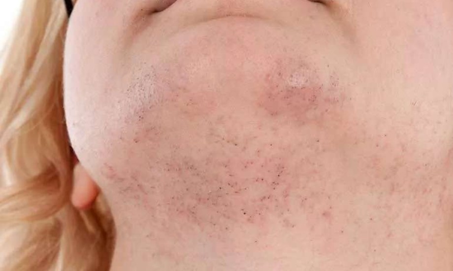 مشاكل صحية تسبب ظهور شعر الذقن عند النساء