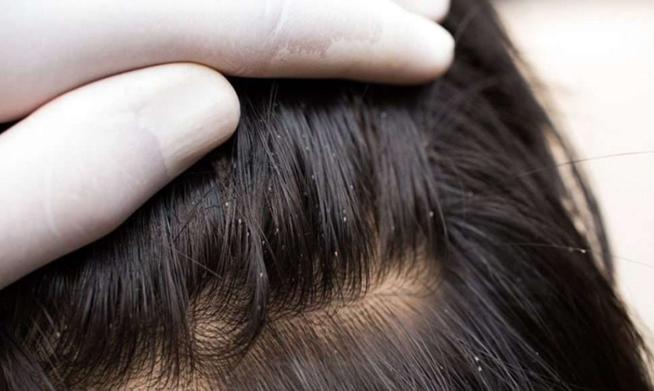 قمل الرأس عند الأطفال