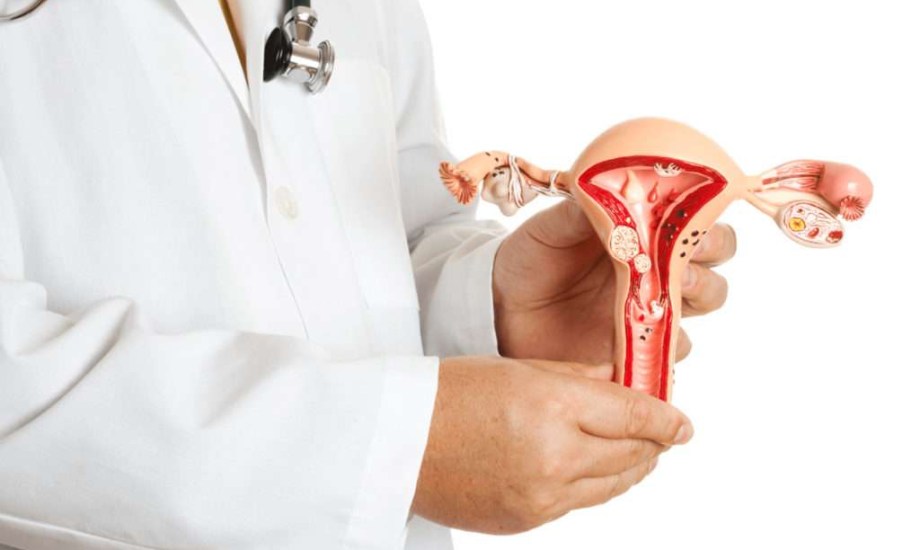  أفضل أنظمة غذائية لمنع تكرار ظهور الأورام الليفية بالرحم