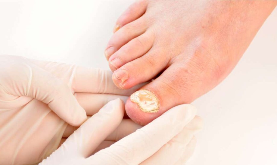 علاج جديد لمرضى عدوى فطريات أظافر القدم