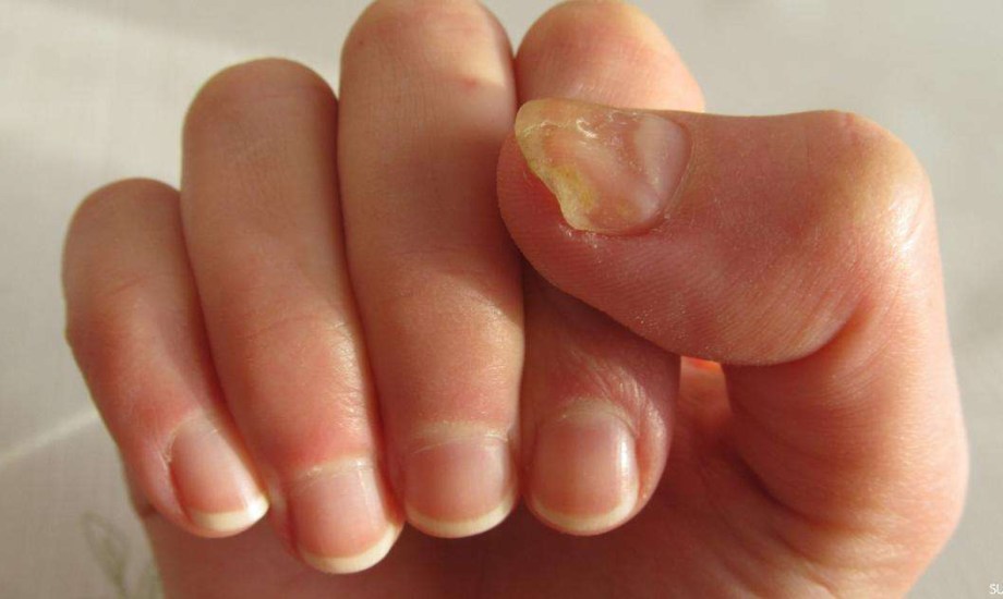 4 طرق للوقاية من فطريات الأظافر