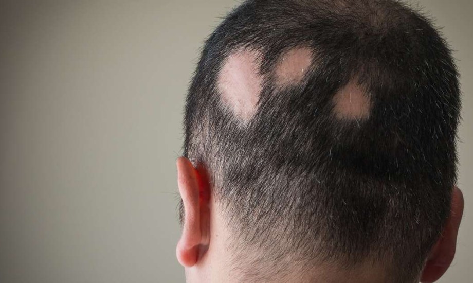 احتياطات على مرضى الثعلبة أخذها عند التعرض للشمس.. و3 علاجات تعزز نمو الشعر