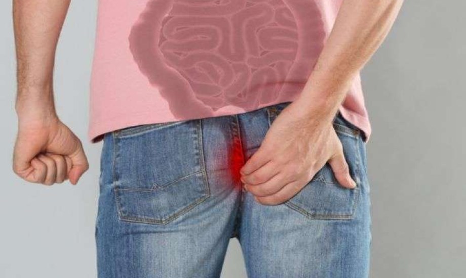 أكثر شيوعا لدى الرجال.. ما أسباب وأعراض وطرق علاج الناسور الشرجي