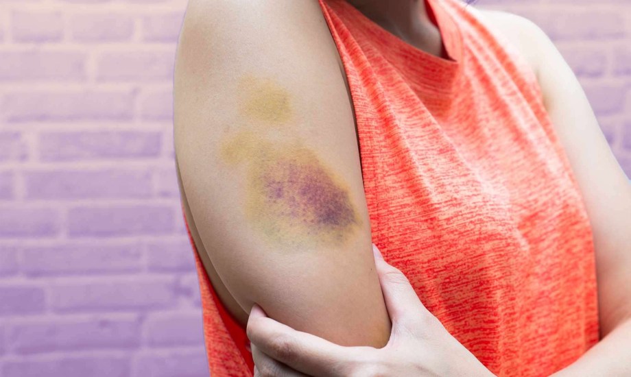 علامات زرقاء في جسمك