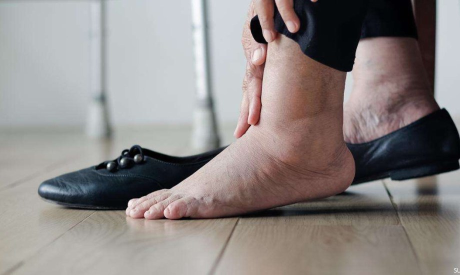 هل تعاني من تورم الساقين؟ 3 فيتامينات تخلصك من هذه المشكلة المزعجة