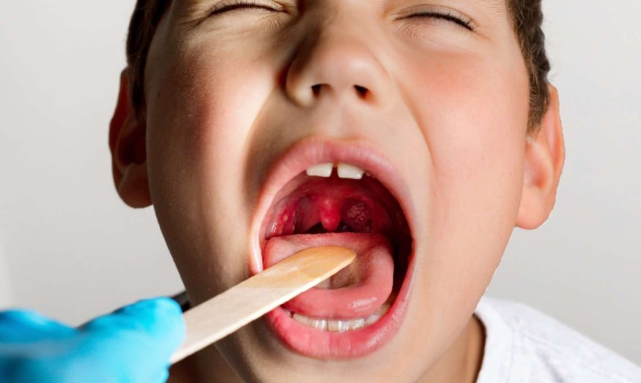 التهاب اللوزتين