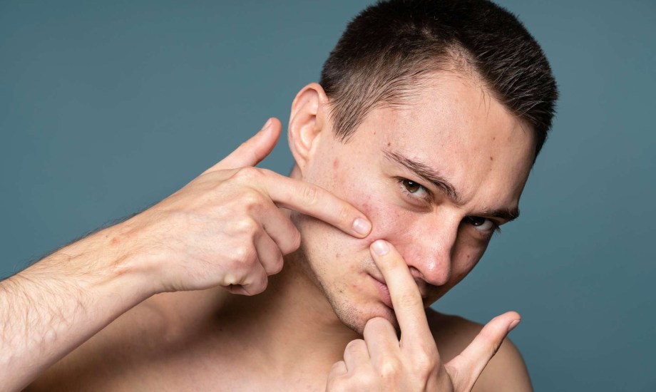 علاج حب الشباب عند الرجال