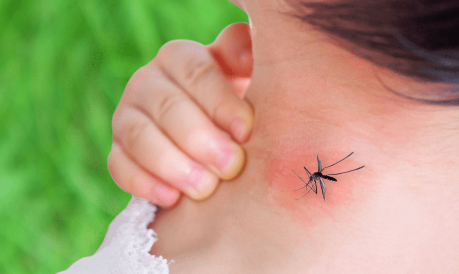 لدغات الحشرات