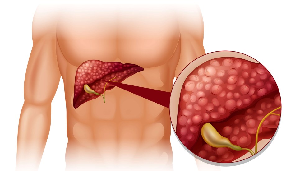 حصوات المرارة