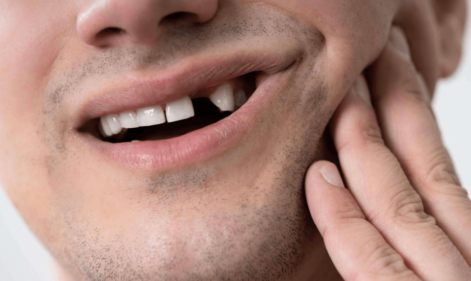 طرق علاج الأسنان المكسورة والمتشققة