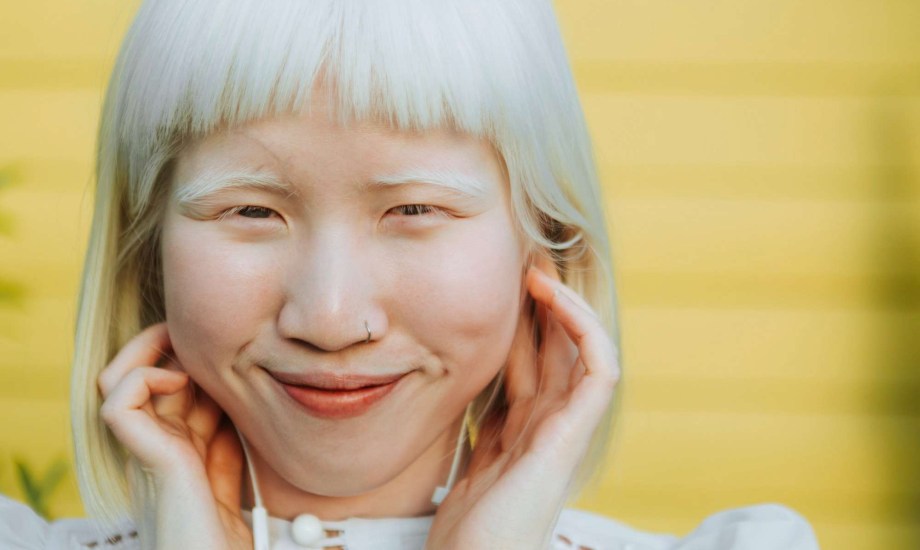 مرض المهق الوراثي