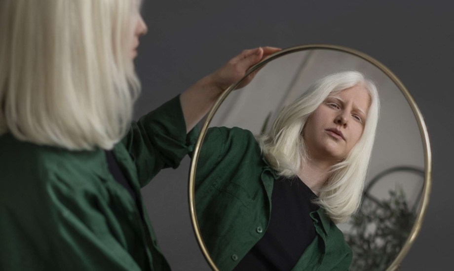 المهق مرض وراثي