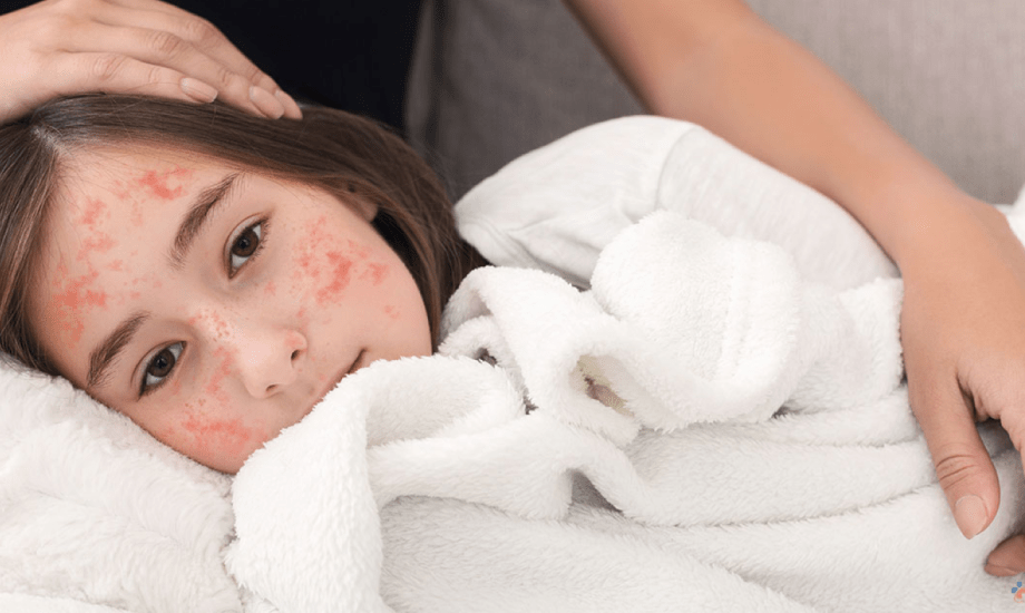 عوامل تزيد احتمالية الإصابة بالحصبة