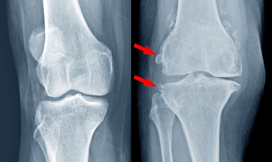 عوامل تزيد خطر هشاشة العظام