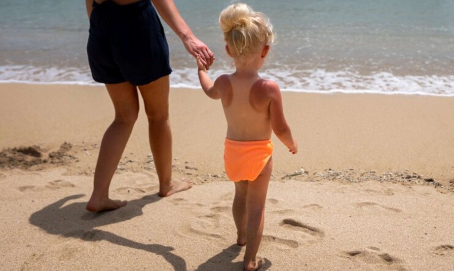 أعراض تشير إلى إصابة الطفل بحروق الشمس