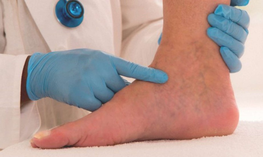 الوذمة وأسبابها وأطعمة تسبب تورم القدمين