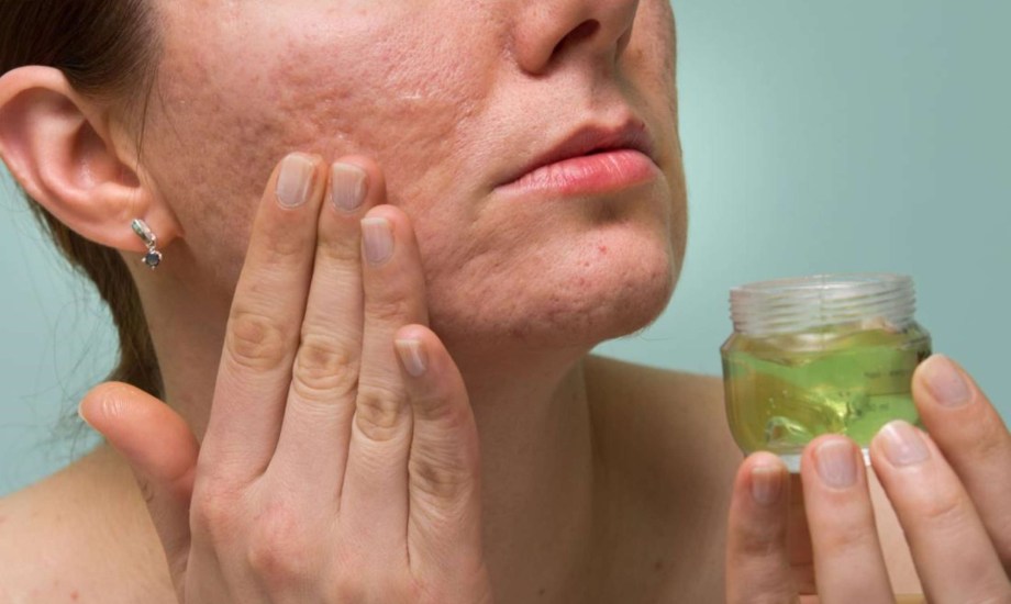 فوائد زيت الجوجوبا وتأثيره في علاج حب الشباب