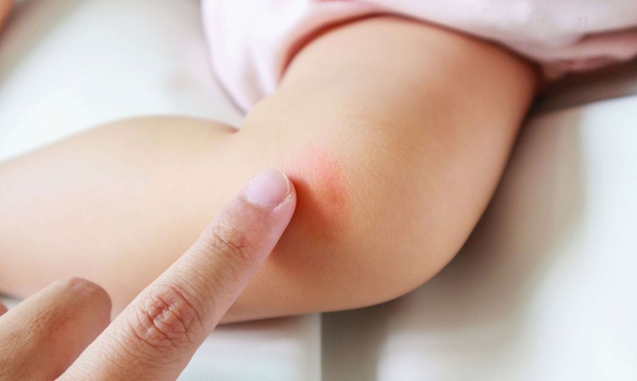 أسباب حساسية الجلد عند الأطفال