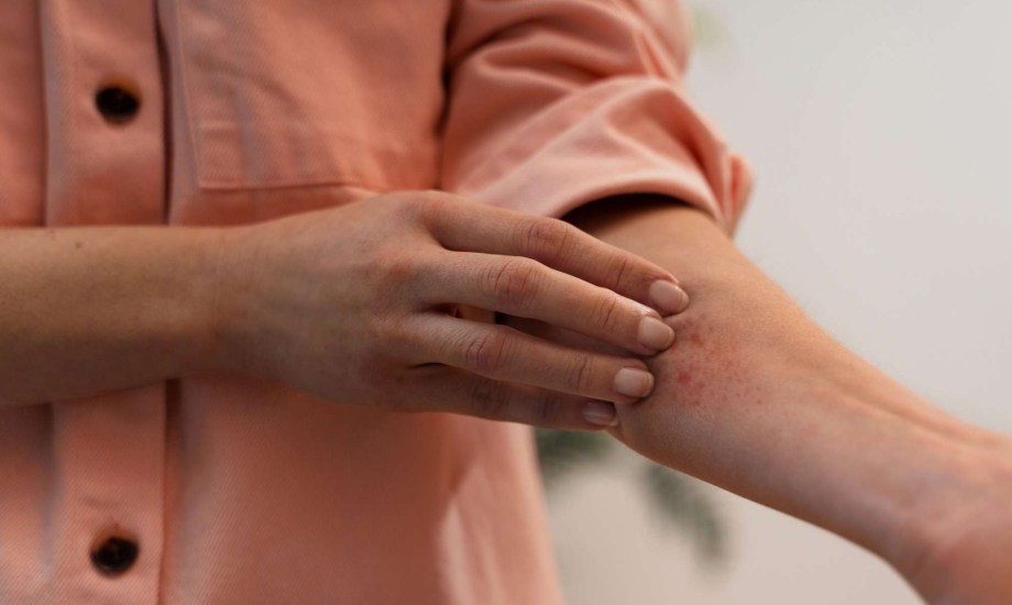 حلول منزلية للقضاء على حمو النيل