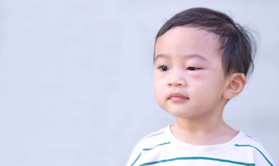 أسباب انتفاخ العيون عند الأطفال 