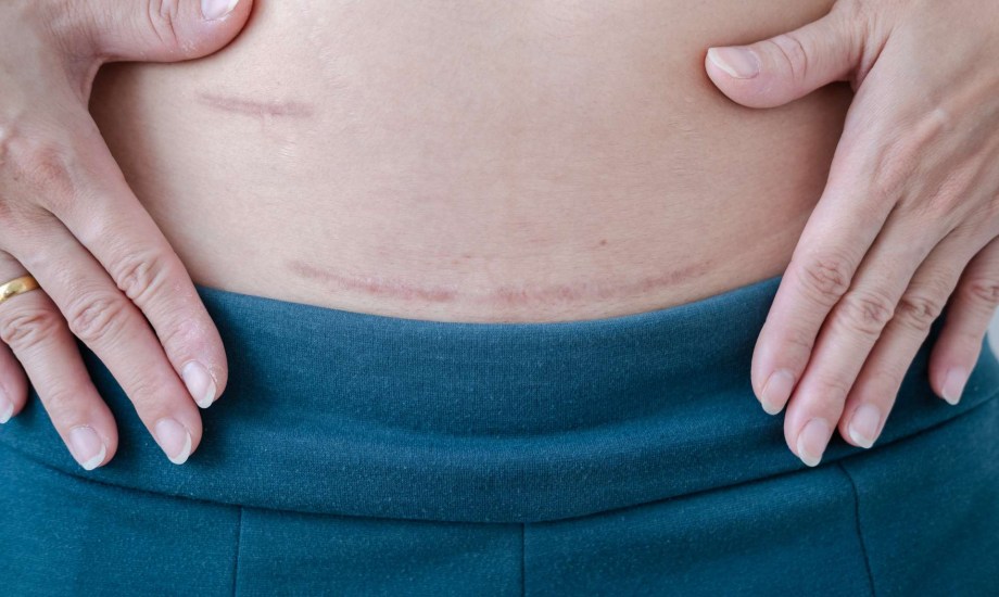 علاج الندبات بتقنية الكاموفلاج