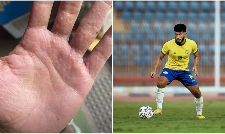 إصابة اللاعب محمد حسن بمرض جلدي