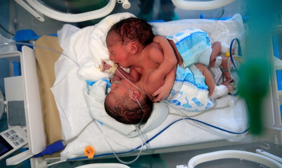 التوأم الطفيلي