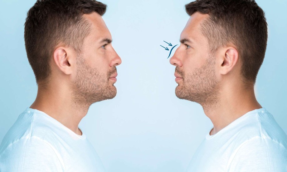 كيف تستعد لعملية تجميل الأنف؟