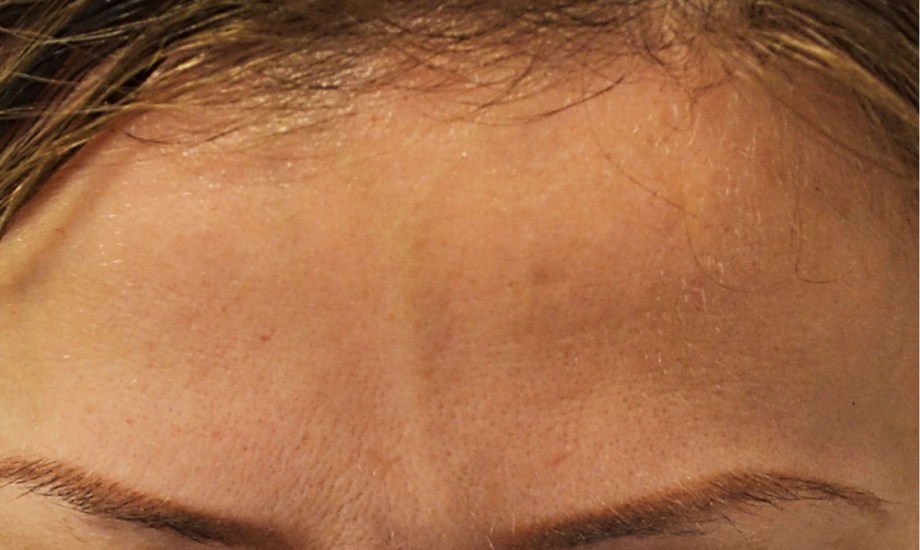 أسباب العروق البارزة في الجبهة