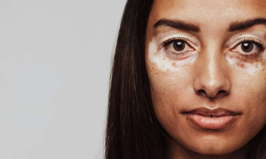 أسباب وطرق علاج مرض البهاق