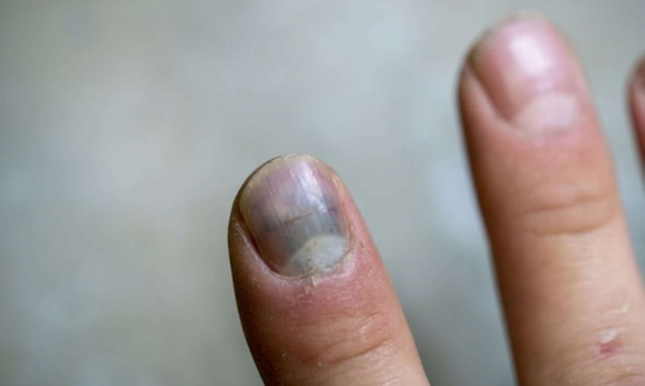 علامات على الأظافر تشير إلى ارتفاع الكوليسترول