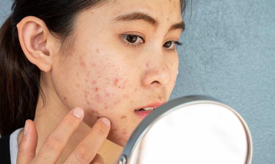 علاجات منزلية لتخفيف حب الشباب