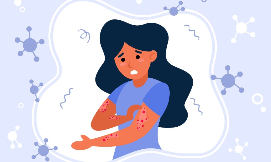 نصائح لعلاج الإكزيما في الصيف