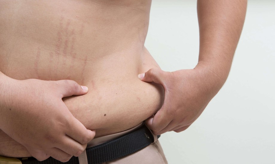 علاجات منزلية وطبية لعلامات التمدد عند الرجال