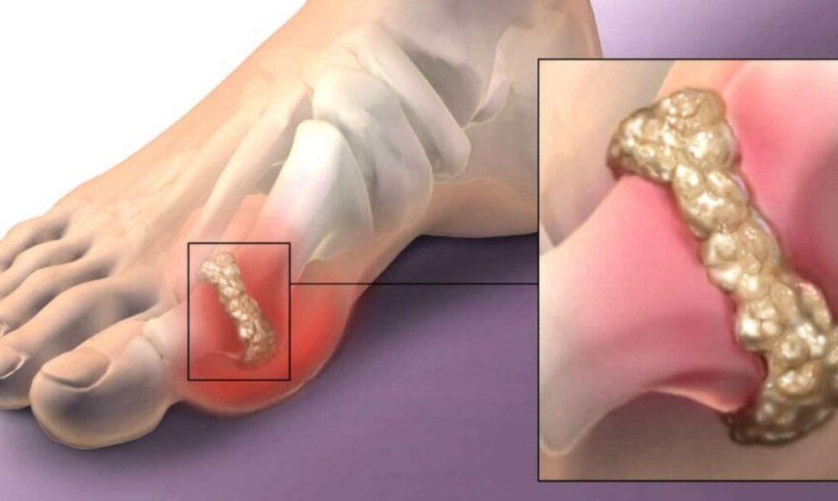 أعراض وأسباب ارتفاع حمض يوريك الدم