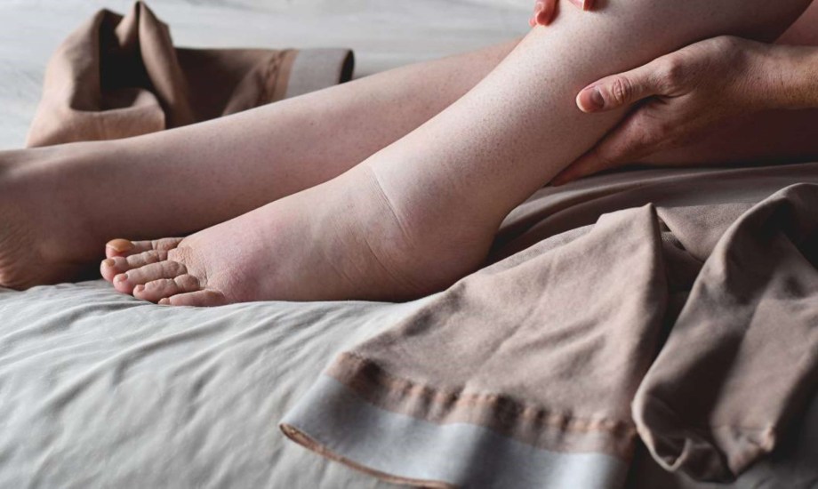 تورم الكاحلين