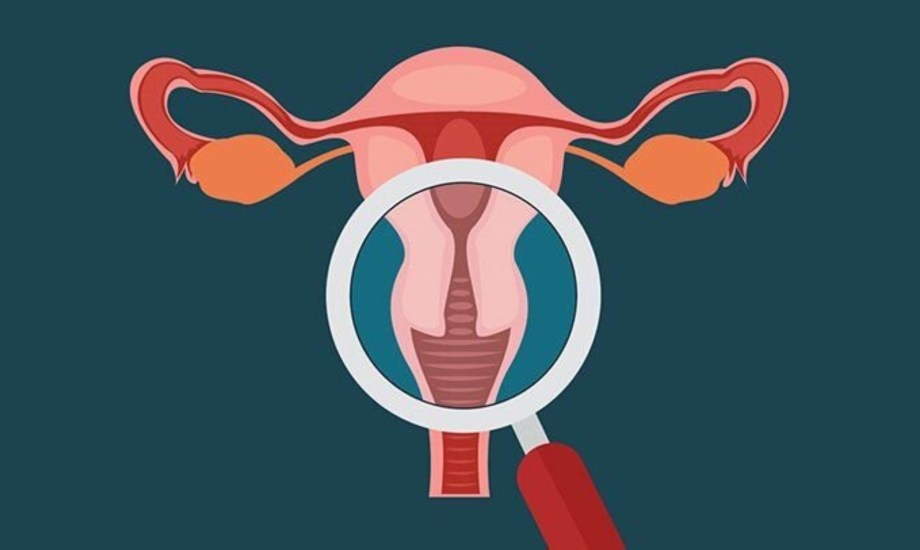 بطانة الرحم المهاجرة تزيد خطر الإصابة بسرطان المبيض