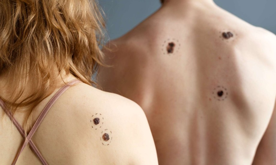 أسباب ظهور الشامات على الجلد