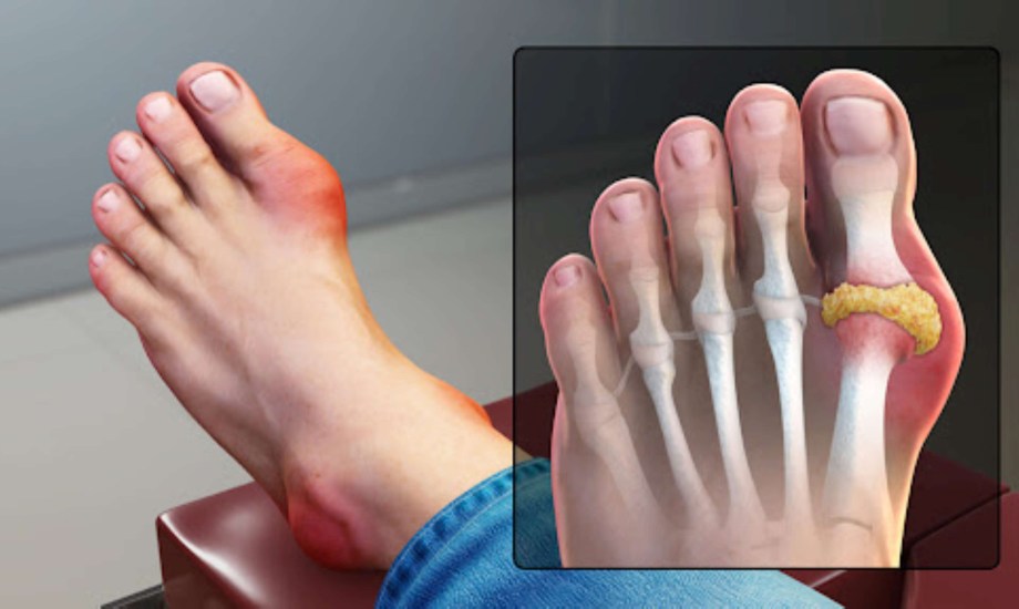 عوامل تؤدي إلى ارتفاع مستوى حمض اليوريك